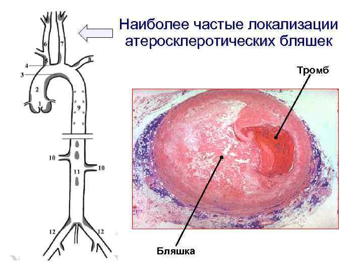 Наиболее частые локализации атеросклеротических бляшек Тромб Бляшка 