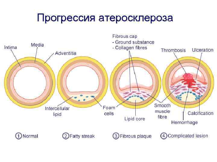 Прогрессия атеросклероза 