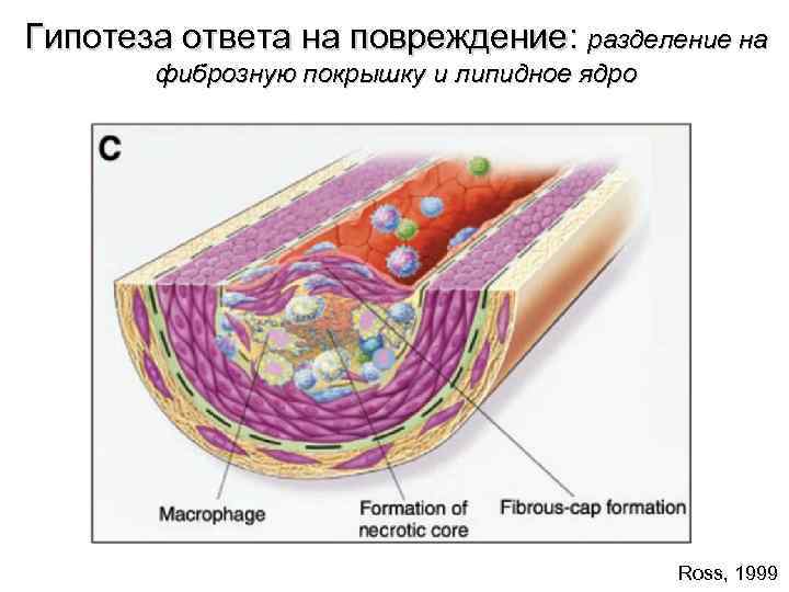 Гипотеза ответа на повреждение: разделение на фиброзную покрышку и липидное ядро Ross, 1999 