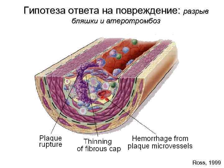 Гипотеза ответа на повреждение: разрыв бляшки и атеротромбоз Ross, 1999 