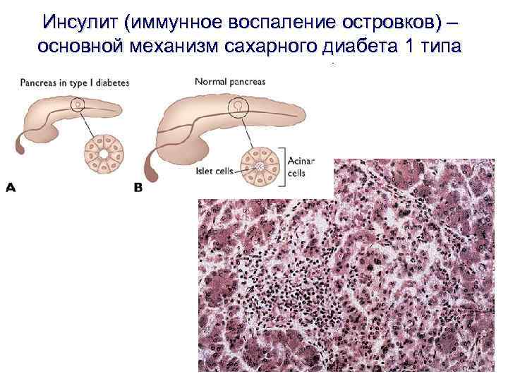 Инсулит (иммунное воспаление островков) – основной механизм сахарного диабета 1 типа 