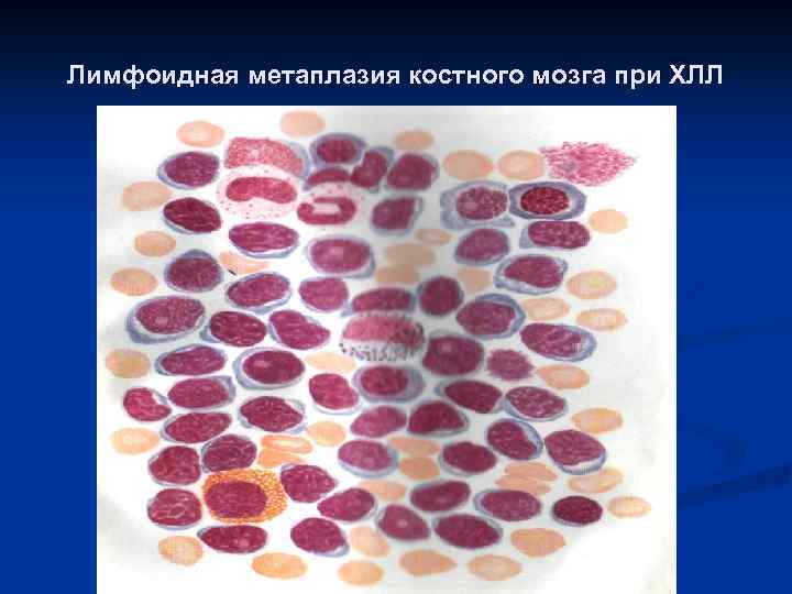 Лимфоидная метаплазия костного мозга при ХЛЛ 