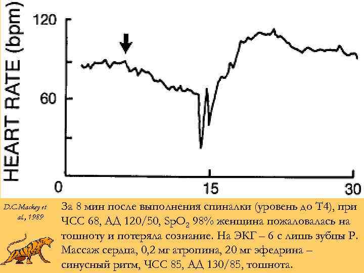 D. C. Mackey et al. , 1989 За 8 мин после выполнения спиналки (уровень