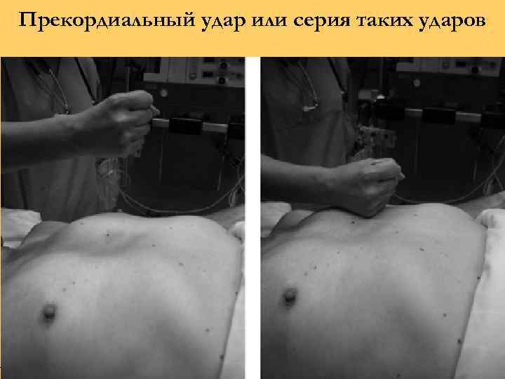 Прекордиальный удар или серия таких ударов 