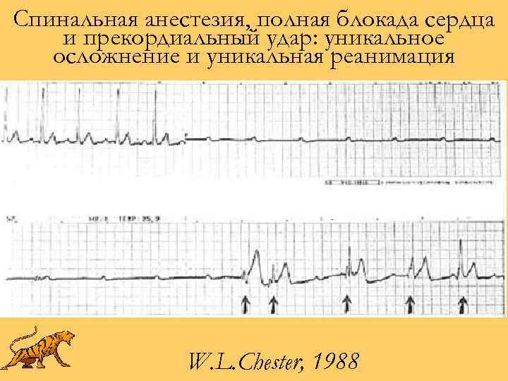 Спинальная анестезия, полная блокада сердца и прекордиальный удар: уникальное осложнение и уникальная реанимация W.