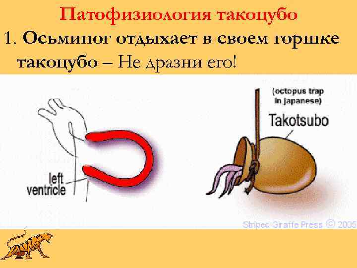 Патофизиология такоцубо 1. Осьминог отдыхает в своем горшке такоцубо – Не дразни его! 