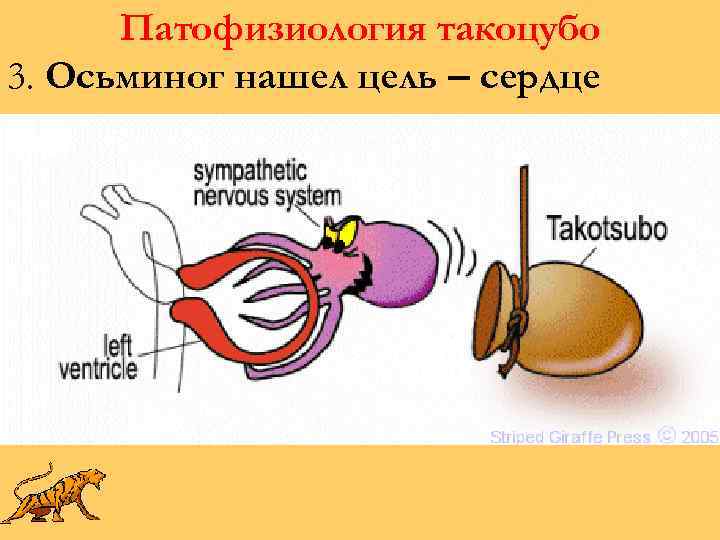 Патофизиология такоцубо 3. Осьминог нашел цель – сердце 