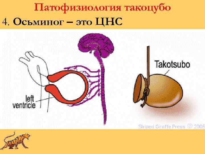 Патофизиология такоцубо 4. Осьминог – это ЦНС 