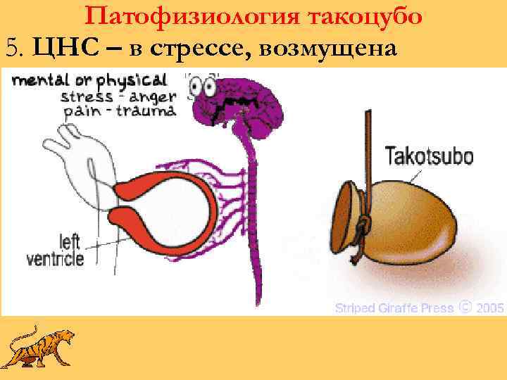 Патофизиология такоцубо 5. ЦНС – в стрессе, возмущена 