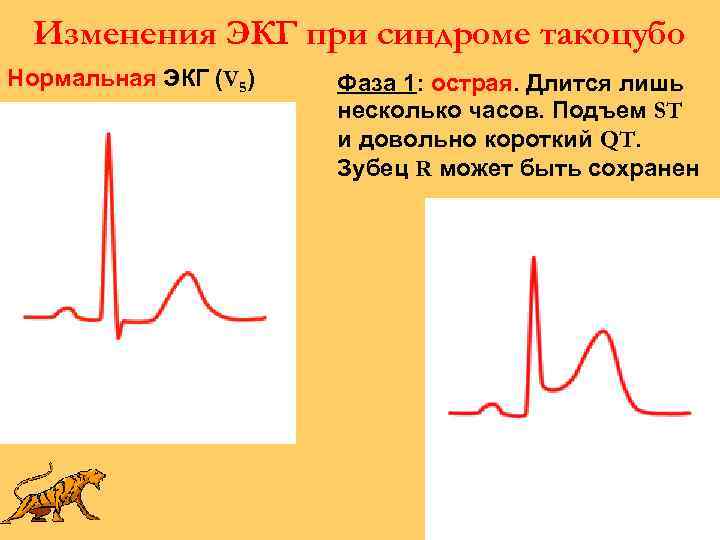 Изменения ЭКГ при синдроме такоцубо Нормальная ЭКГ (V 5) Фаза 1: острая. Длится лишь