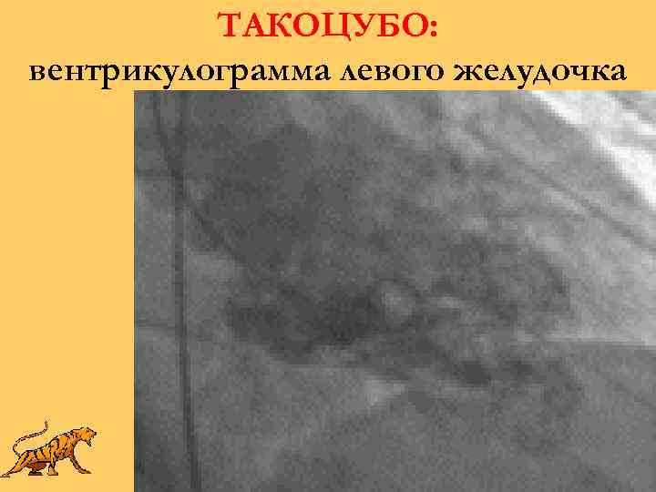 ТАКОЦУБО: вентрикулограмма левого желудочка 