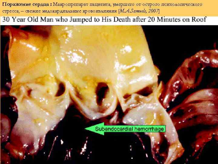 Поражение сердца : Макропрепарат пациента, умершего от острого психологического стресса, – свежие эндокардиальные кровоизлияния