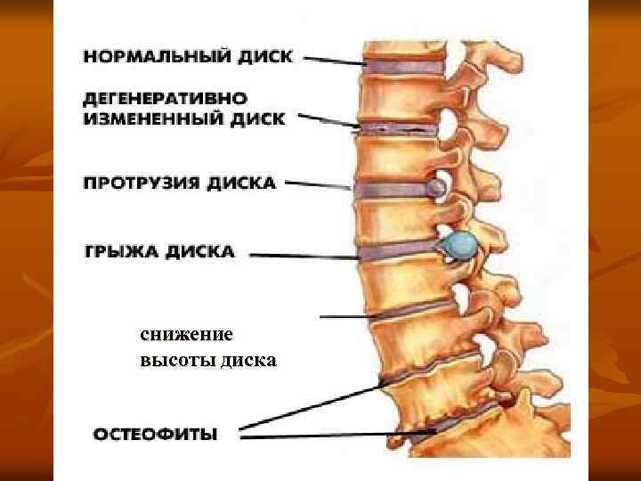 снижение высоты диска 