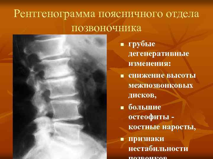 Мр картина дегенеративных изменений поясничного отдела позвоночника