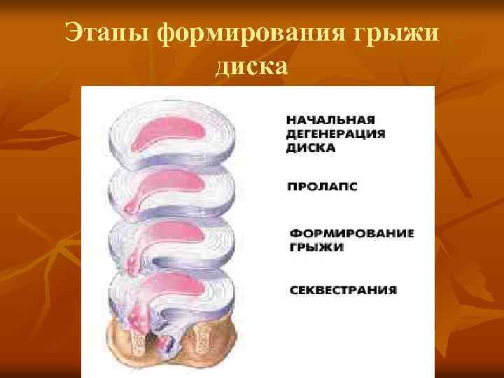 Этапы формирования грыжи диска 