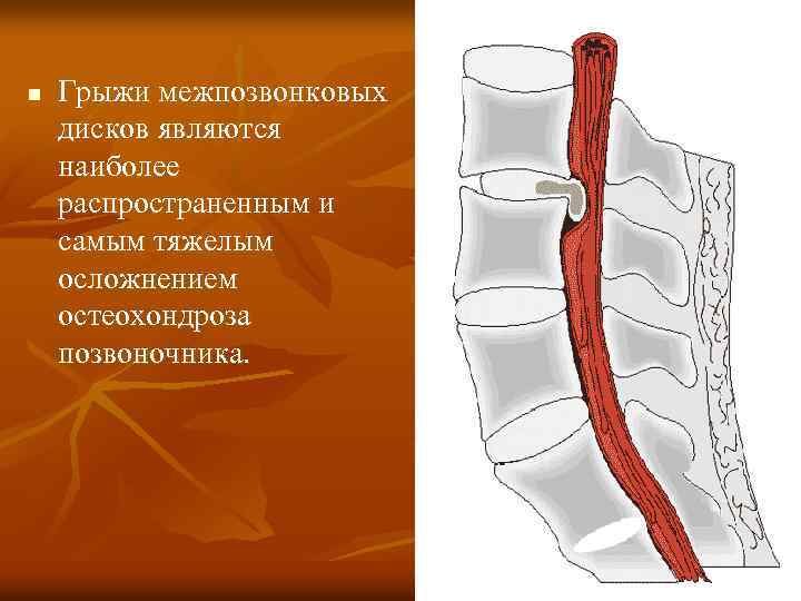 Вертеброгенная компрессия. Вертеброгенные поражения периферической нервной системы. Классификация вертеброгенных заболеваний периферической нервной. Классификация вертеброгенных поражений. ПНС это в медицине.