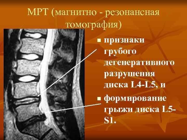 Люмбалгия карта вызова