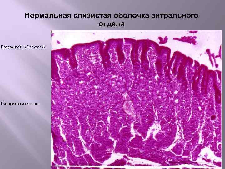 Антральные железы желудка. Слизистая антрального отдела желудка гистология. Кишечная метаплазия желудка гистология. Атрофия слизистой желудка гистология. Желудок хронический гастрит гистология.