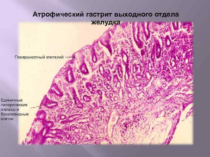 Атрофический гастрит выходного отдела желудка Поверхностный эпителий Единичные пилорические железы и бокаливидные клетки