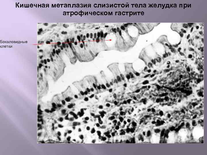 Кишечная метаплазия слизистой тела желудка при атрофическом гастрите Бокаловидные клетки 