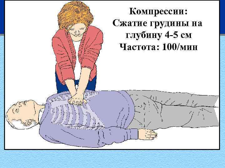 Компрессии: Сжатие грудины на глубину 4 -5 cм Частота: 100/мин 