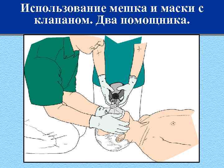 Использование мешка и маски с клапаном. Два помощника. 