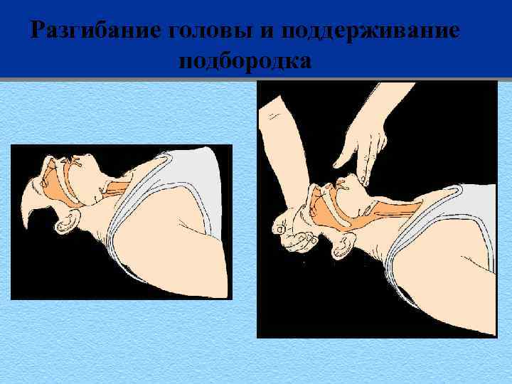 Разгибание головы и поддерживание подбородка 