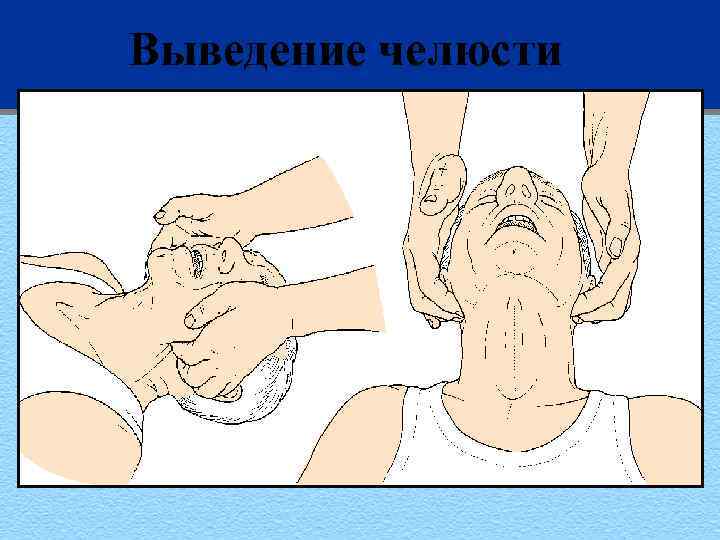 Выведение челюсти 