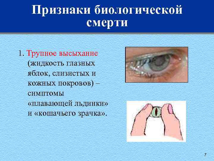 Признаки биологической смерти 1. Трупное высыхание (жидкость глазных яблок, слизистых и кожных покровов) –