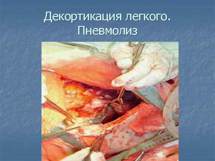 Декортикация легкого. Пневмолиз 