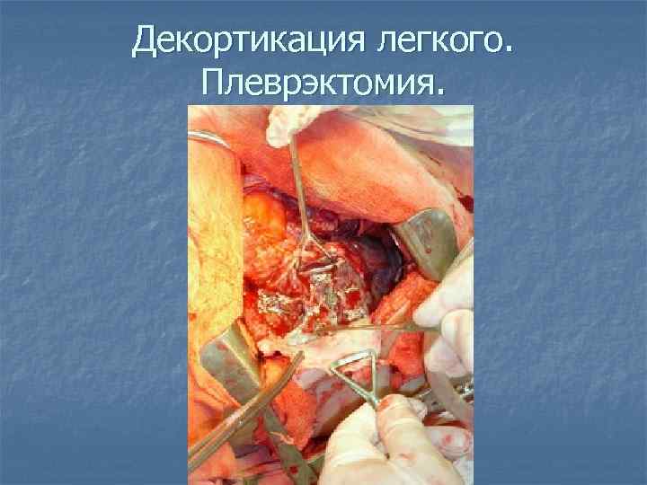 Декортикация легкого. Плеврэктомия. 