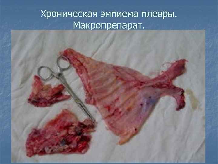 Хроническая эмпиема плевры. Макропрепарат. 