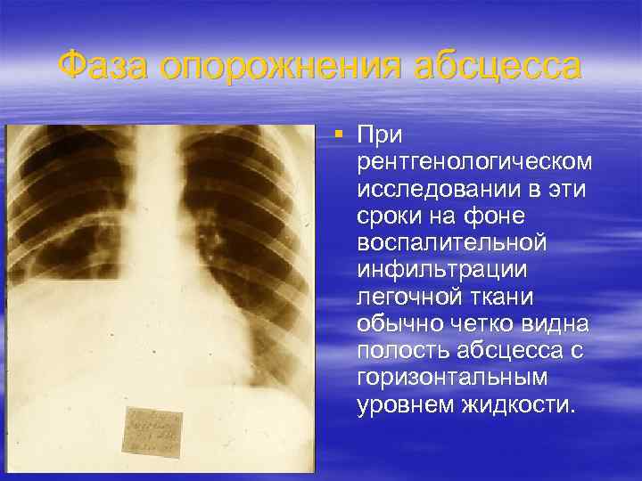 Фаза опорожнения абсцесса § При рентгенологическом исследовании в эти сроки на фоне воспалительной инфильтрации