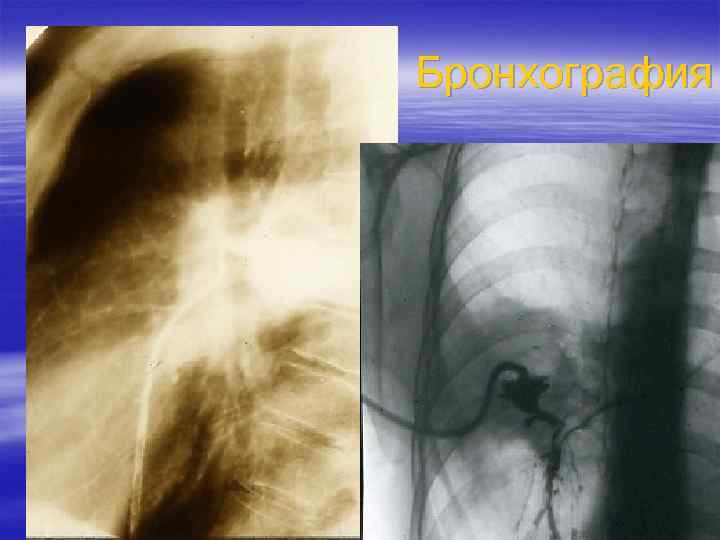 Бронхография 