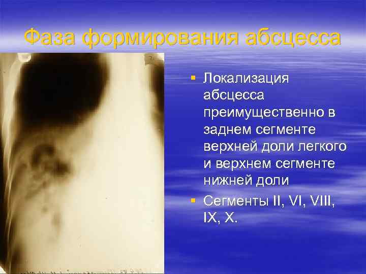 Фаза формирования абсцесса § Локализация абсцесса преимущественно в заднем сегменте верхней доли легкого и