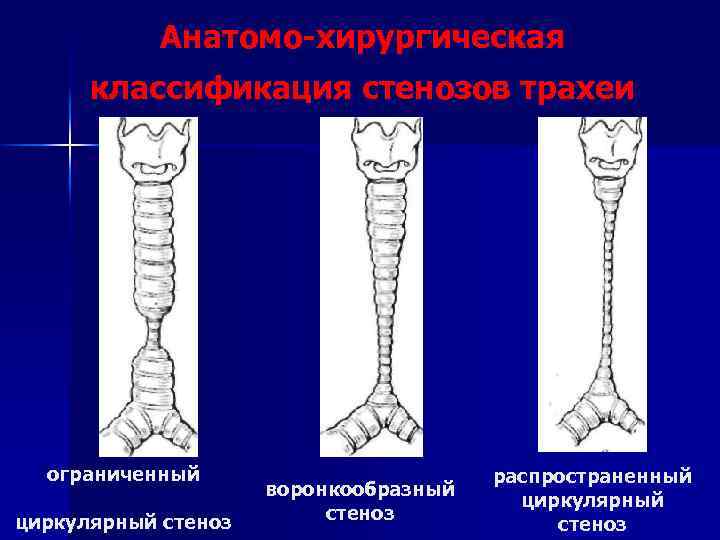 Анатомо-хирургическая классификация стенозов трахеи ограниченный циркулярный стеноз воронкообразный стеноз распространенный циркулярный стеноз 