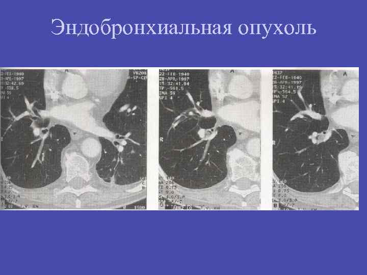 Эндобронхиальная опухоль 