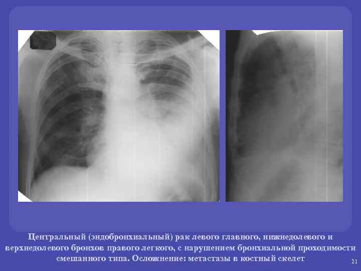 Центральный (эндобронхиальный) рак левого главного, нижнедолевого и верхнедолевого бронхов правого легкого, с нарушением бронхиальной