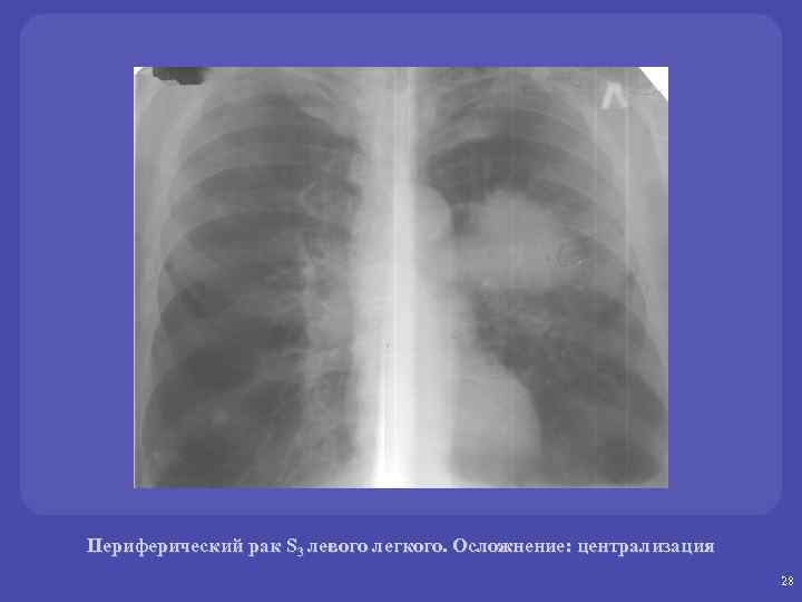 Как выглядит периферический рак легкого на компьютерной томографии