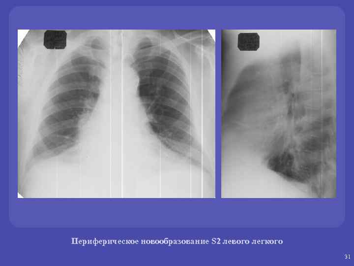 Периферический рак левого легкого. Периферическая опухоль легкого. Периферическое образование легкого. Периферическое образование левого лёгкого. Периферическое образование s3 левого легкого.