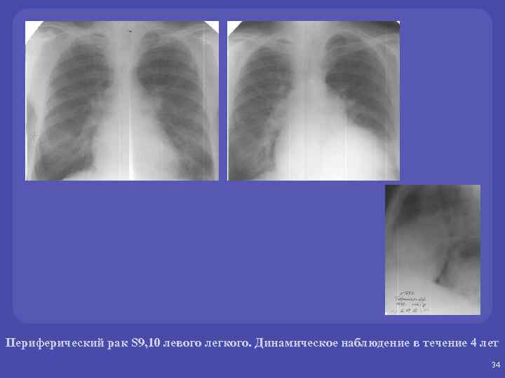 Периферический рак S 9, 10 левого легкого. Динамическое наблюдение в течение 4 лет 34