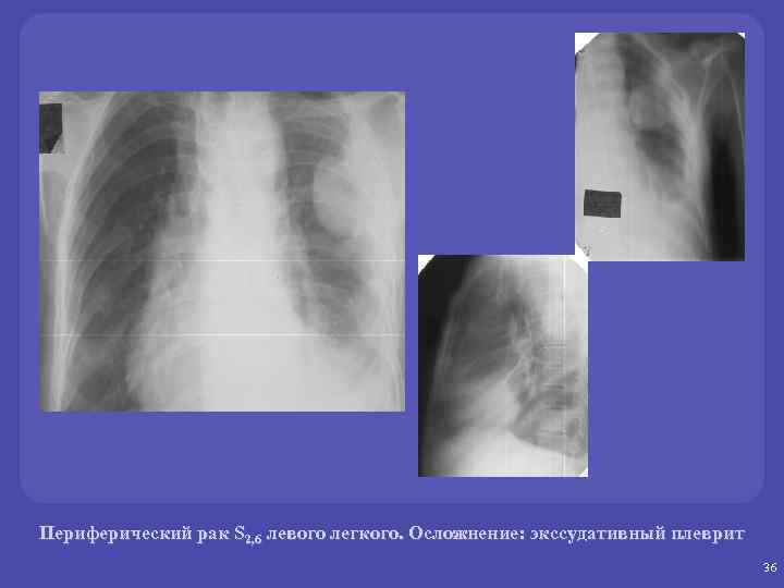 Периферический рак левого легкого. Экссудативный плеврит рентгенограмма. Периферическое образование левого легкого. Метатуберкулезные изменения в легких рентген. Метатуберкулезные изменения рентген.