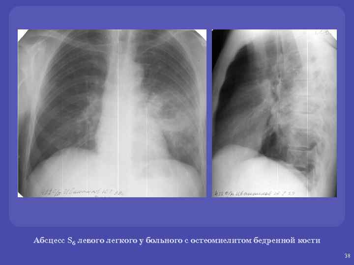 Абсцесс S 6 левого легкого у больного с остеомиелитом бедренной кости 38 