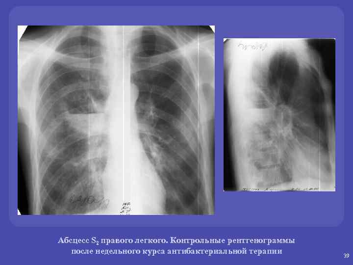 Абсцесс S 2 правого легкого. Контрольные рентгенограммы после недельного курса антибактериальной терапии 39 