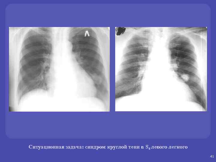 Ситуационная задача: синдром круглой тени в S 4 левого легкого 41 