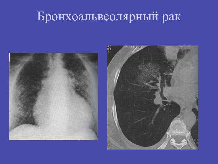 Бронхоальвеолярный рак презентация