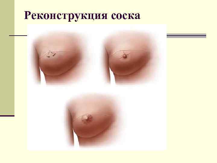 Реконструкция соска 