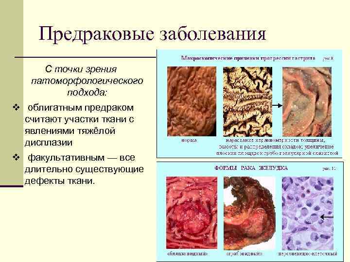 Предраковые заболевания С точки зрения патоморфологического подхода: v облигатным предраком считают участки ткани с