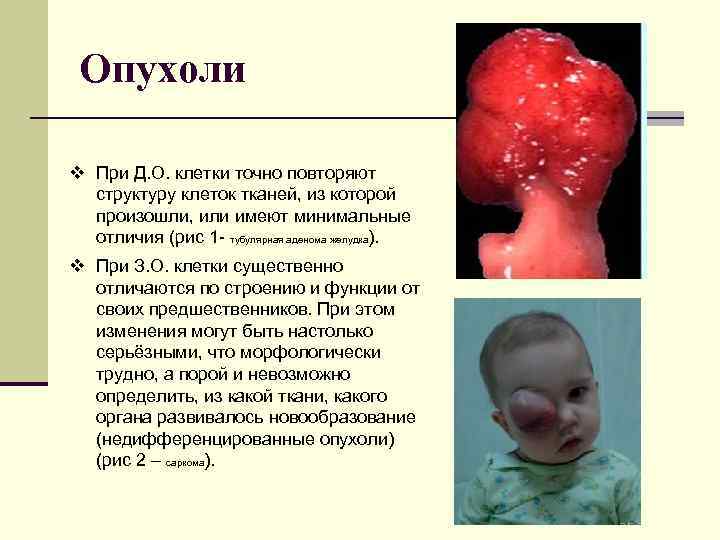 Опухоли v При Д. О. клетки точно повторяют структуру клеток тканей, из которой произошли,