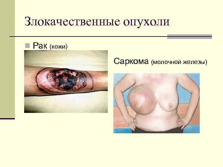 Злокачественные опухоли Рак (кожи) Саркома (молочной железы) 